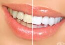 Предимства на избелването на зъби в домашни условия