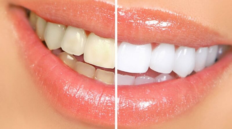 Предимства на избелването на зъби в домашни условия